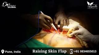 Tummy Tuck Surgery / Abdominoplasty step by step video performed by expert cosmetic surgeon in Pune