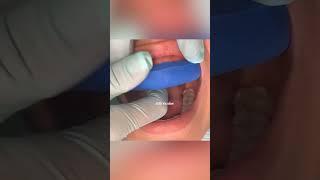 Trial smile | smile makeover | Dr. Yazdan #cosmeticdentistry porcelain crowns front teeth procedure
