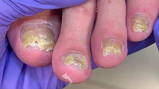 Treat mottled onychomycosis, all 5 toenails are infected【Doctor Liu Pedicure】