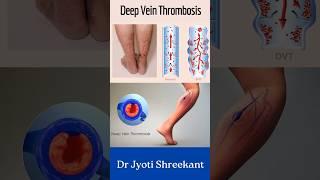 Deep vein thrombosis #shorts