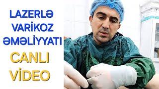 endovenoz lazer ablasiya varikoz damar emeliyyati fleboloq damar cerrahi ismayil esgerov total EVLA