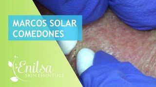 Marcos Solar Comedones Extractions