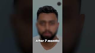 Hair Transplant 7 Months Results | Clinic  | Dadu Medical Centre