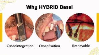 "Hybrid Basal Implants: The Future of Dental Tech? "