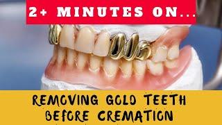 Will You Remove Gold Teeth Prior to Cremation? Just Give Me 2 Minutes