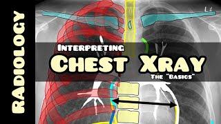 Reading a chest X-ray | Radiology