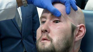 Man receives world’s first eye transplant after high-voltage electrical accident