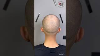 Маскировка облысения на затылке - трихопигментация, татуировка волос. SMP Scalp micropigmentation