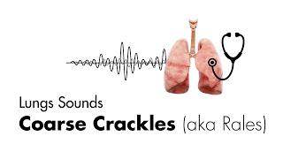 Coarse Crackles (Rales) - Lung Sounds - Medzcool