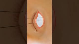 Causes of Droopy Eyelid (Ptosis) video credit: Fauquier ENT (Youtube.com)