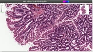 Traditional Serrated Adenoma - Histopathology