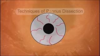 New Simple Limbal Epithelial Transplantation SLET   Dr Virender Sangwan