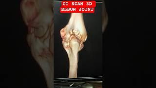 CT SCAN ELBOW JOINT #jointpain #fracture #siemens #3d #doctor  #radiology