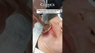 TREATMENT LASER CO2 FRACTIONAL | CLARICE BEAUTY CLINIC