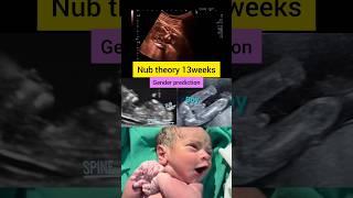 Nub theory 13weeks#babyboy #babygirl #pregnancy #ultrasound