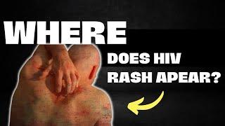 Where Does Hiv Rash Apear ?