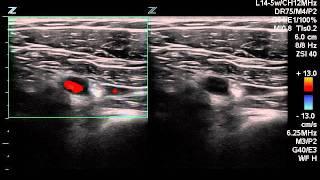 Infraclavicular Sweep SAFE ZONE imaging (ZONARE 2011)