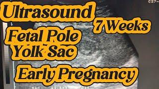 What Does an Early Pregnancy Ultrasound Reveal | 7Weeks Pregnancy Ultrasound The Art of Baby Imaging