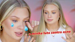 Maquia e fala - A minha batalha com acne