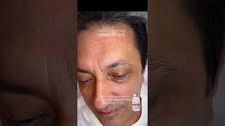 PRXT терапия-омоложение без уколов. 998997291117 Ольга Мир  #skincare #filler