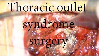 TOS | Thoracic Outlet Syndrome Surgery | Dr Kamran Aghayev | Neurosurgeon | neurosurgery |