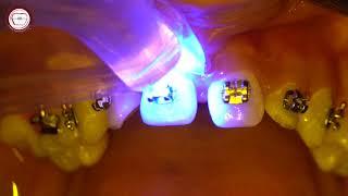 Braces bonding step by step in orthodontics & wire insertion