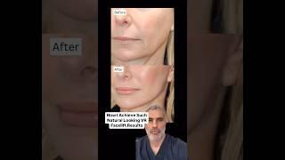 Dr. Amir Karam's SECRET to Achieve NATURAL, AGELESS Facelift Transformations!