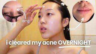 How I Get Rid of Acne FAST (great for sensitive skin!)