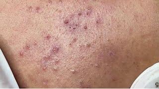 Remove blackheads on dry skin #HoangMySpa72