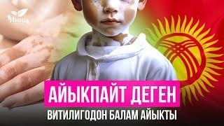 Баламдын көзүндөгү ала (витилиго) кетти