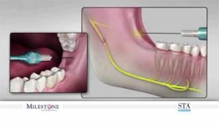 The Wand® STA Instrument - Inferior Alveolar mandibular Block