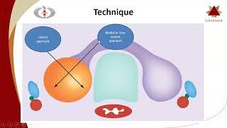 Thyroid Ablation, Dr  Arun Gupta, Department of Interventional Radiology, Sir Ganga Ram Hospital