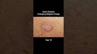 Skin Cancer Development Time Lapse (Normal to Squamous Cell Carcinoma Over 25 Years)