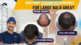 Hair Transplant In Bangalore | Best Surgeon Center & Results Of Hair Transplant In Bangalore