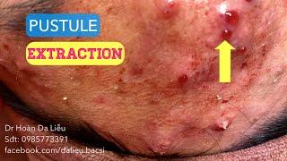 Mụn mủ viêm mặt cực nặng|Dermatologist,pimples,whitehead blackhead,anti acne,pustule acne extraction