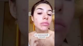 #советы #биоревитализация #косметология #косметолог #botox #контурнаяпластика #губы #акне