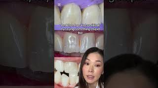 “You have no cavities. But we will monitor the cracks.” Yikes. #cracks #crazelines #enamel #dentist