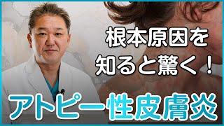 【知ると驚愕】なぜアトピー性皮膚炎になるのか？