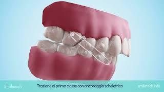 Smiletech: Trazione Elastica