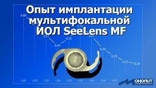 Опыт имплантации мультифокальной ИОЛ SeeLens MF