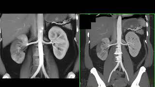 CT of the Acute Abdomen:  GU Applications Part 2