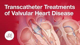 Transcatheter Treatments of Valvular Heart Disease