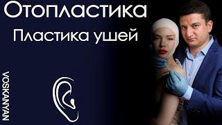 Отопластика ушей,  пластика ушных раковин . Коррекция ушей