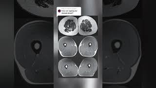 The Muscle Loss of Ageing
