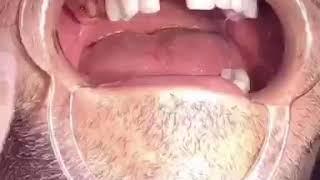 Full Mouth Reconstruction Try in, Zirconia Crowns, Miami - Dr.Svetlana Anokhina DDS