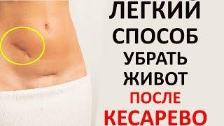 Как Убрать Живот После Кесарева Сечения? (т)