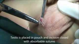 Orchiopexy surgery for both sided Undescended testis in a child- Dr A.K.Singal, Mumbai, India