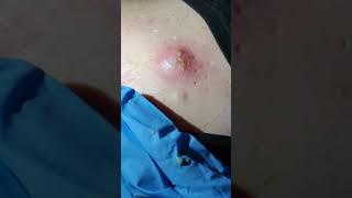 The biggest pimple pop of 2020?? EXPLODING Spot/Pimple/Cyst popping **please see description