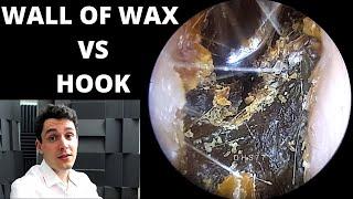 Great Wall Of Ear Wax VS Metal Hook