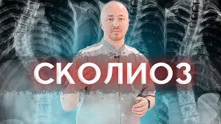 Как определить:  сколиоз или сколиотическая осанка? Почему даже врачи ошибаются?